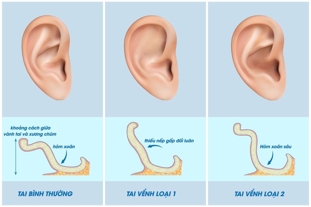 So sánh giữa các dạng tai vểnh và tai bình thường