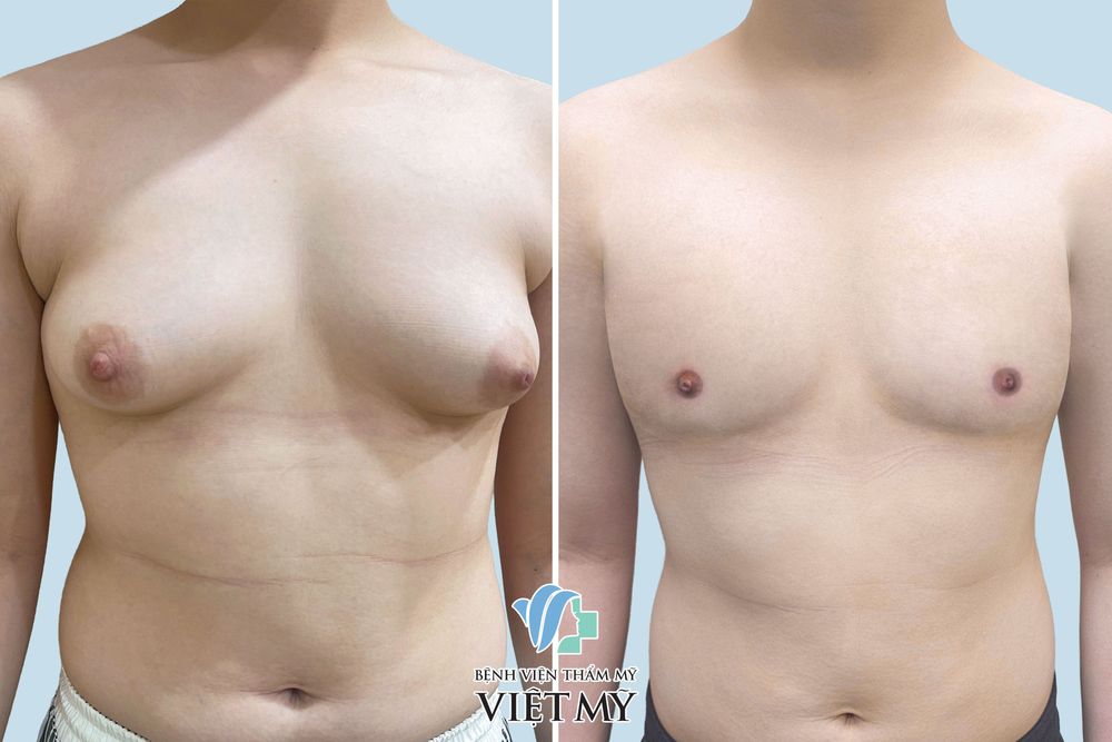 Hình ảnh trước và sau phẫu thuật nữ thành nam đường viền quầng vú.