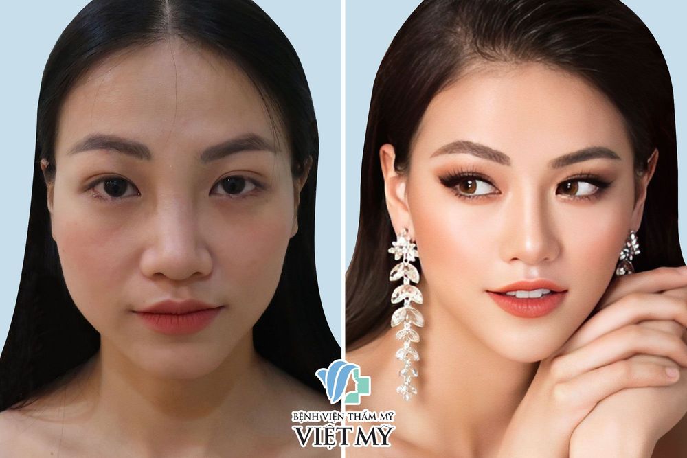 Hoa hậu Phương Khánh phẫu thuật sửa mũi