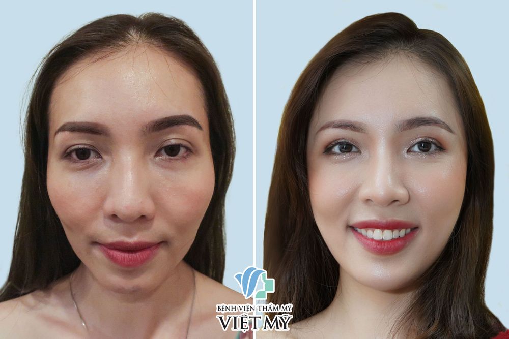 khách hàng trở nên trẻ trung hơn sau khi tiêm mỡ thái dương, má 