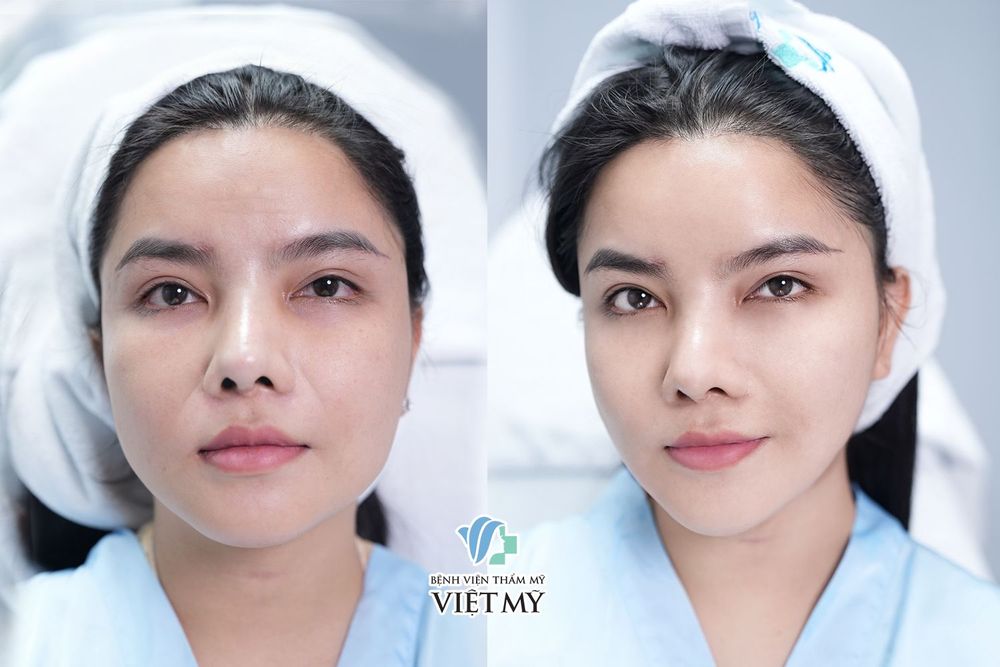 Sau khi làm Ultherapy Prime cần chăm sóc da như thế nào?