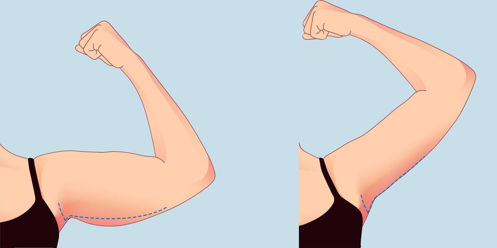 sẹo ở nách sau hút mỡ