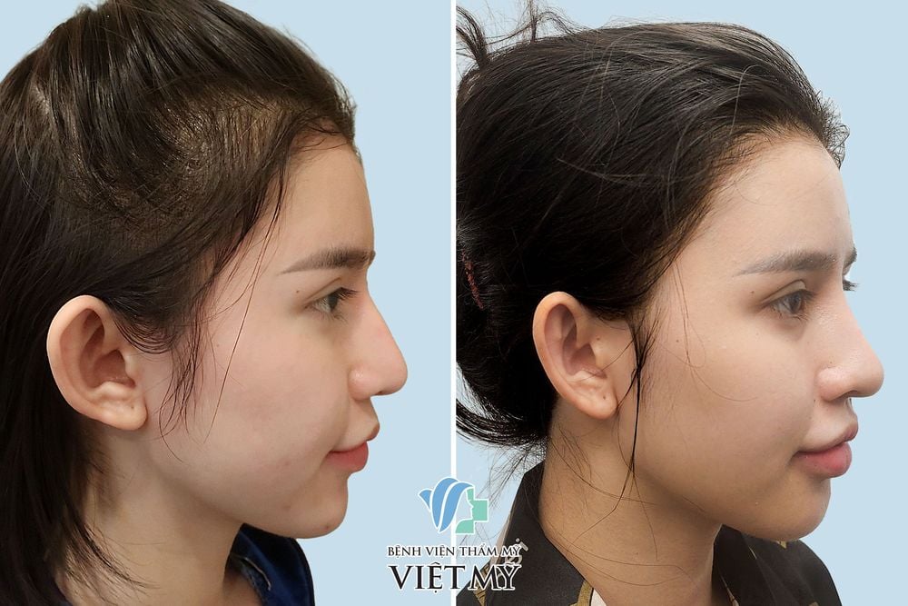 tạo hình tai bị vểnh