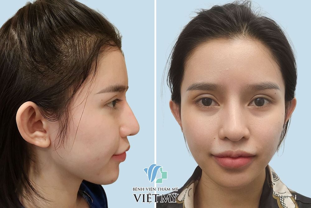 tạo hình tai bị vểnh