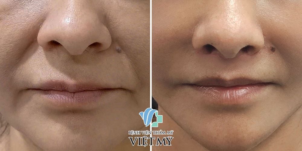 làm ngắn nhân trung.