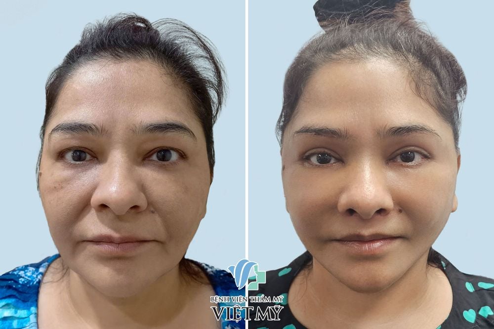 làm ngắn nhân trung.