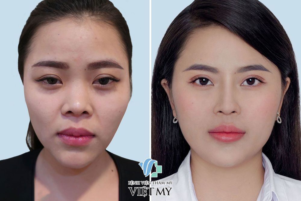 Khách hàng sau khi được tiêm mỡ má, thái dương