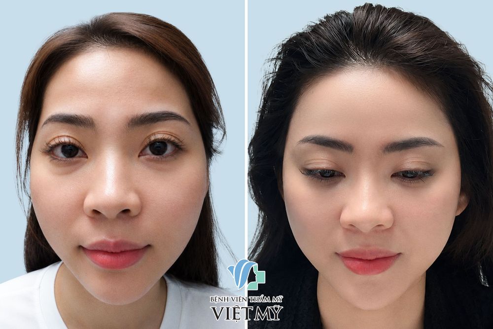 Khách hàng trước và sau tiêm filler làm đầy thái dương