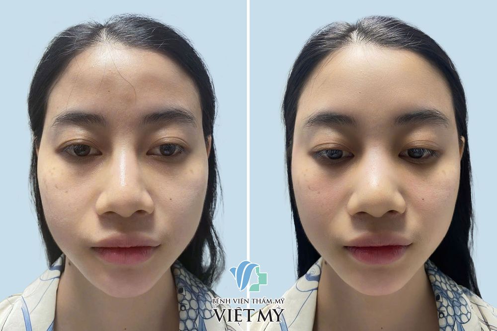 Khách hàng trước và sau tiêm filler làm đầy thái dương