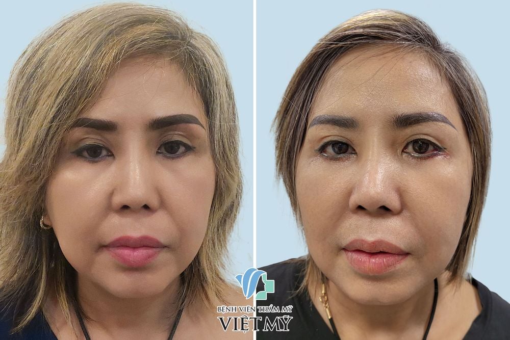  tiêm mỡ hốc mắt