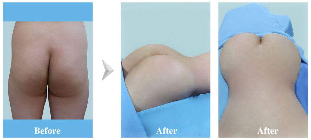 Images before and after undergoing abdominoplasty and butt lift using autologous fat.