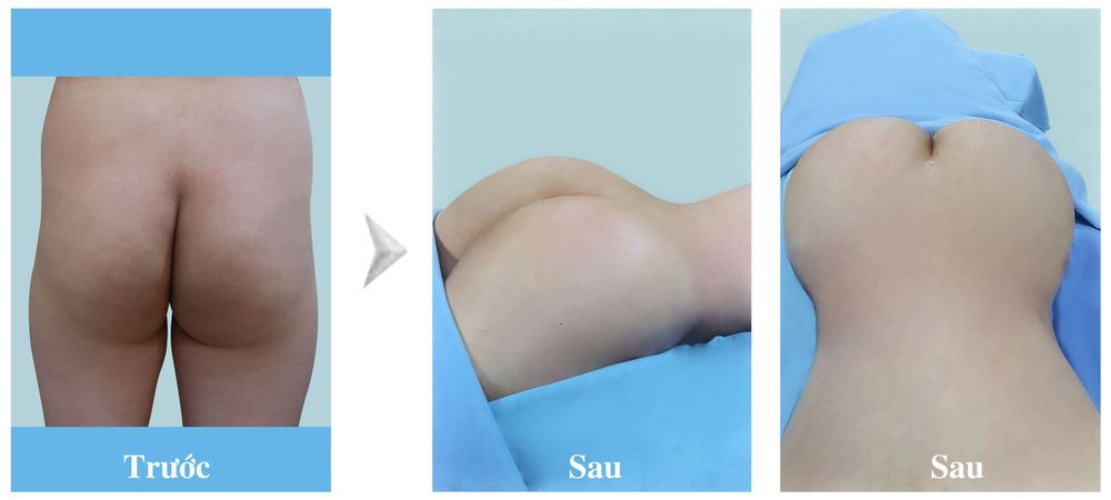 Nâng Mông Nội Soi - Độn Mông Nội Soi - bác sĩ Chiêm Quốc Thái