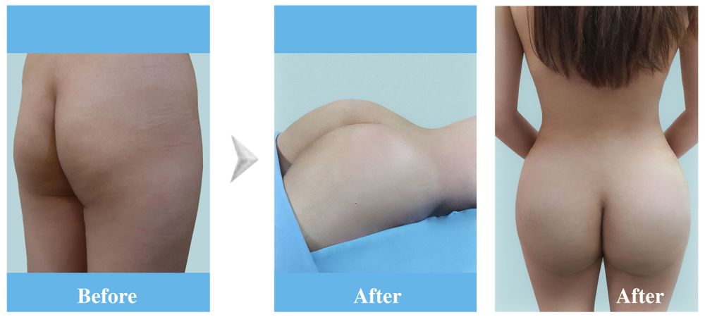 Images before and after undergoing abdominoplasty and butt lift using autologous fat.