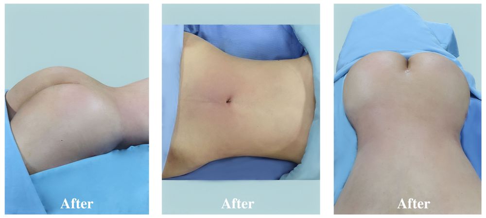 A 32-year-old client after undergoing butt lift using autologous fat