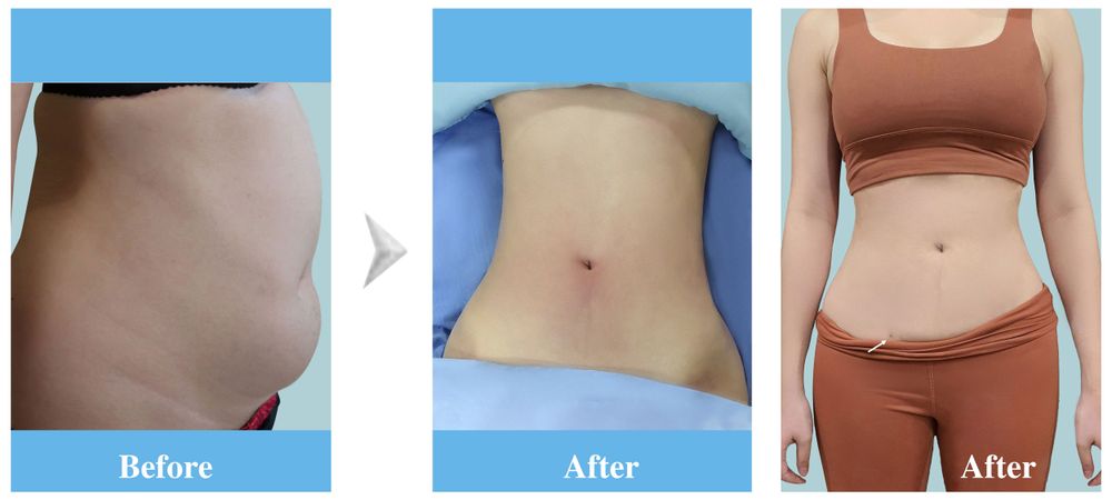 Images of a 22-year-old client before / after undergoing liposuction and butt lift using autologous fat