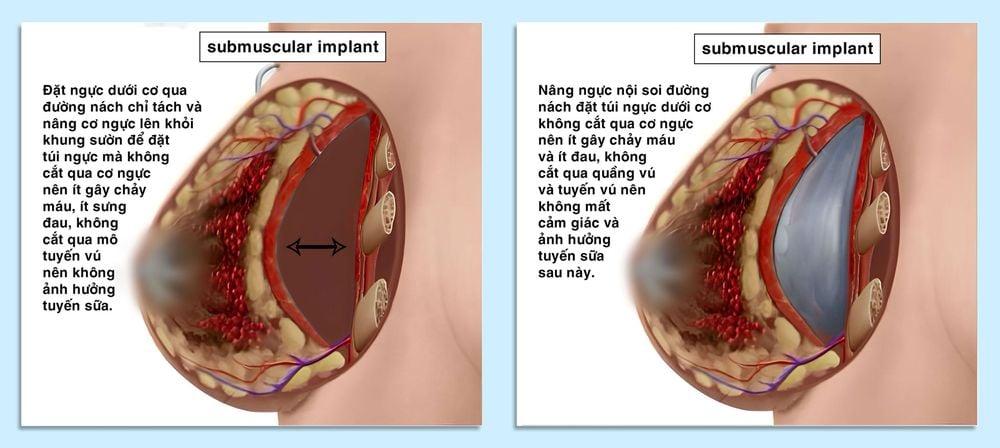 Nâng ngực nội soi đường nách đặt dưới cơ