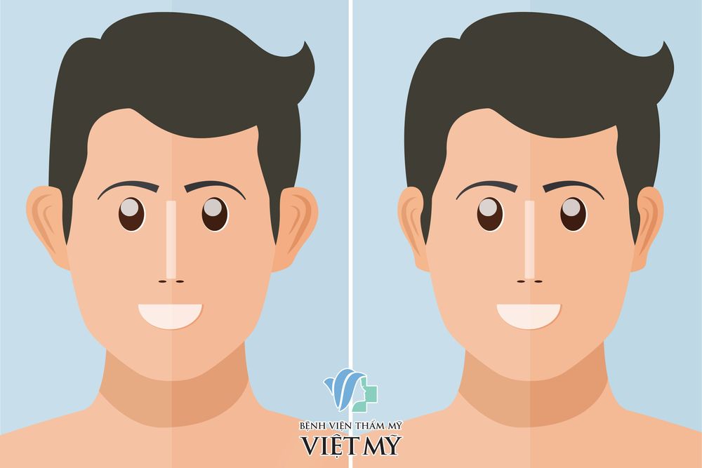 thẩm mỹ tai vểnh