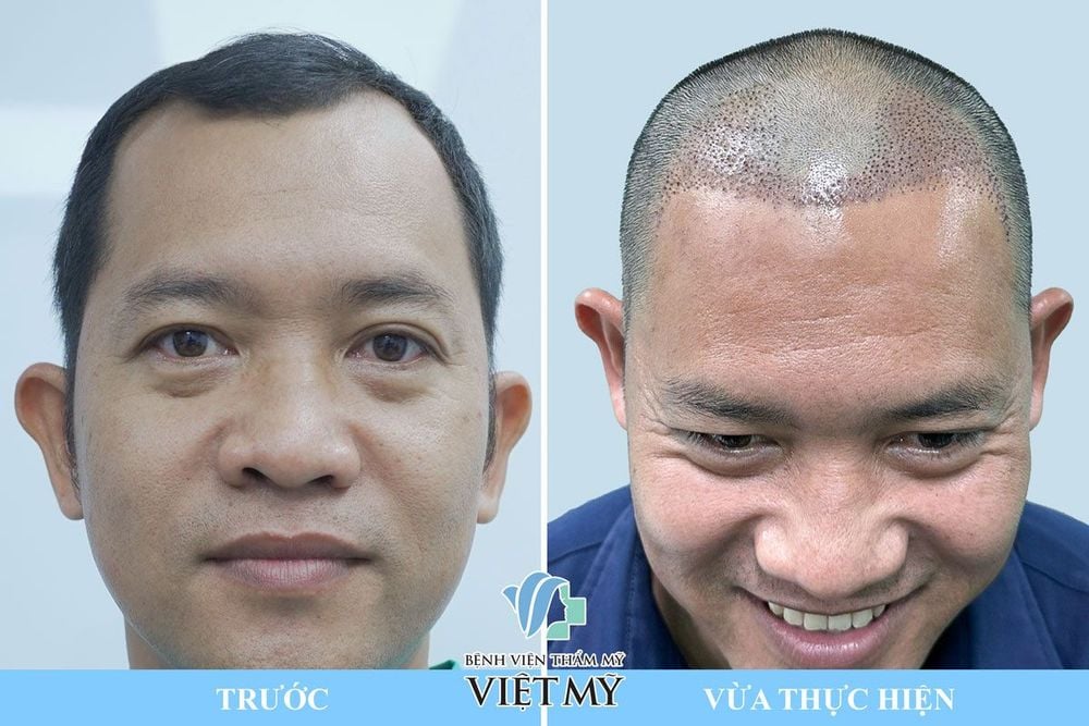 Cấy tóc DHI (FUE)  – Cấy tóc trực tiếp