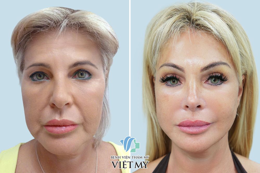 Khách hàng U60 căng da mặt