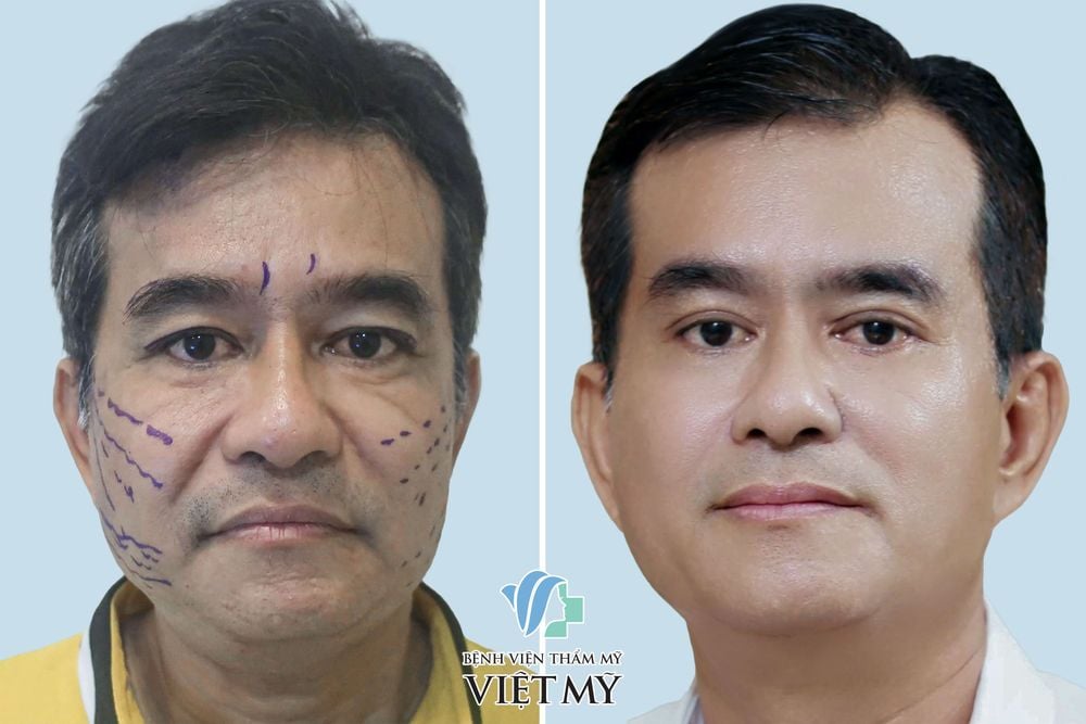Khách hàng 60 tuổi cắt mắt 2 mí, cắt mí dưới, căng da mặt chỉ và làm đầy rãnh mũi má bằng mỡ tự thân.