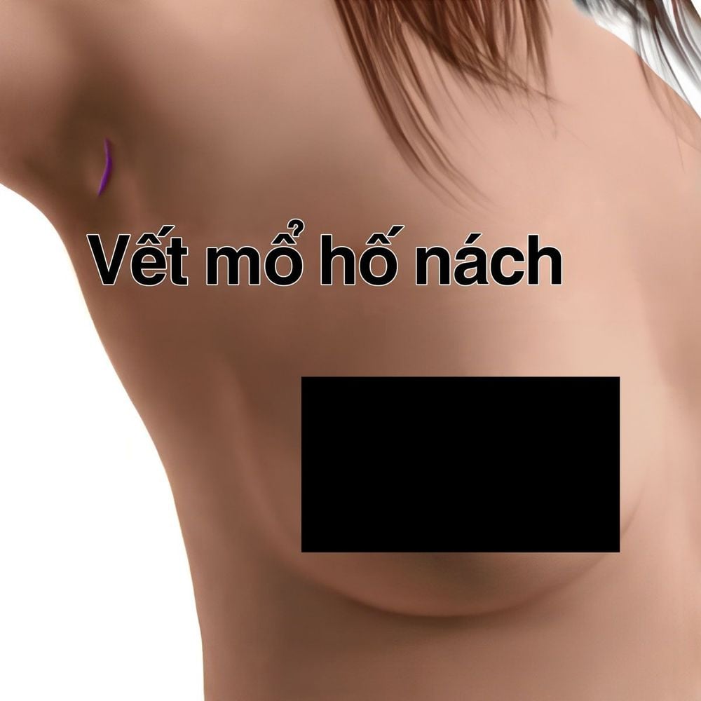 Vết  mổ hố nách