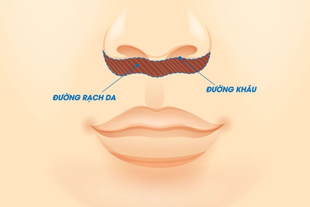 Vị trí đường mổ và rạch da trong phẫu thuật làm ngắn nhân trung