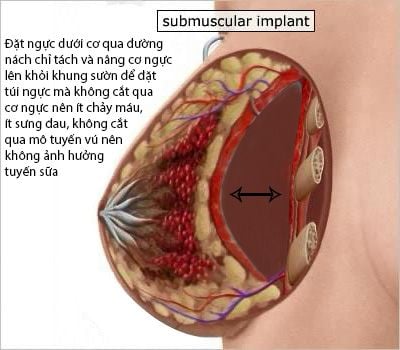 Hình ảnh chi tiết túi nâng ngực đặt dưới cơ qua dạ vú và qua đường nách.