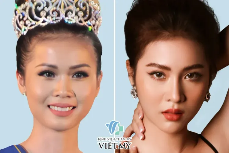 Hoa hậu Kim Ngọc trước và sau khi nâng mũi và phẫu thuật thẩm mỹ toàn diện.