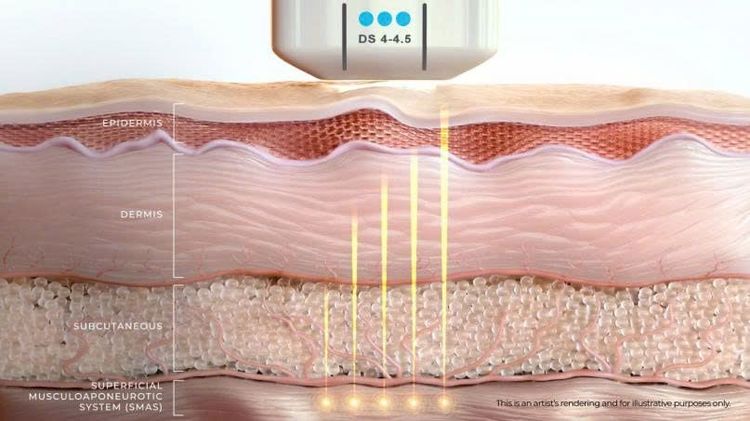 Vì sao Ultherapy Prime được gọi là "chuẩn vàng" nâng cơ không phẫu thuật