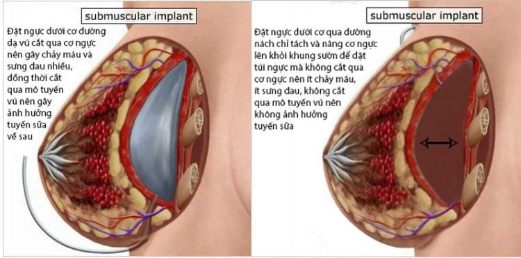 Đặt ngực dưới cơ có lớp cơ ngực che phủ nên không bị lộ túi.