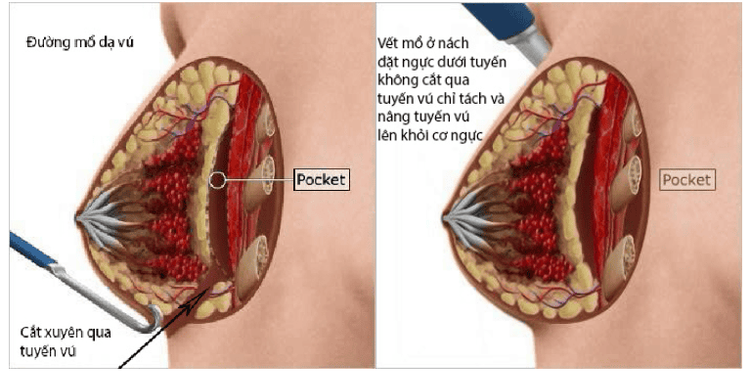 Nâng ngực mổ hở nếp dạ vú