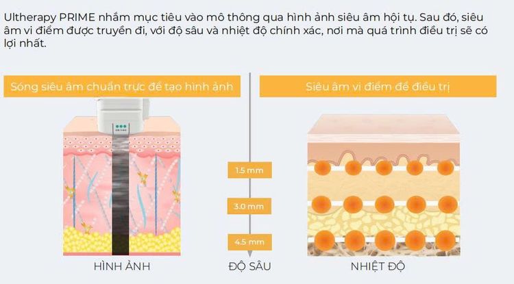 Vì sao Ultherapy Prime được gọi là "chuẩn vàng" nâng cơ không phẫu thuật