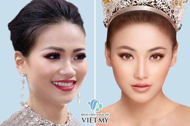 Hoa hậu Phương Khánh trước và sau nâng mũi, phẫu thuật thẩm mỹ toàn diện.