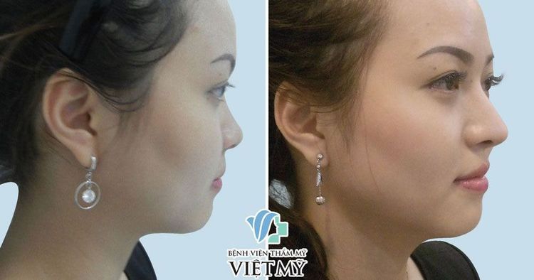 A client before and after undergoing rhinoplasty and alarplasty