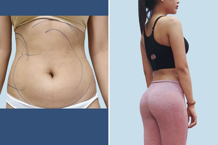 Hình ảnh trước/sau của khách hàng hút mỡ bụng Lipo Ultrasound và bơm mỡ tự thân vào mông