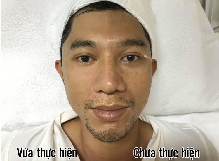 Ultherapy căng da mặt không phẫu thuật - Nâng Cơ Trẻ Hóa Da - bác sĩ Chiêm Quốc Thái