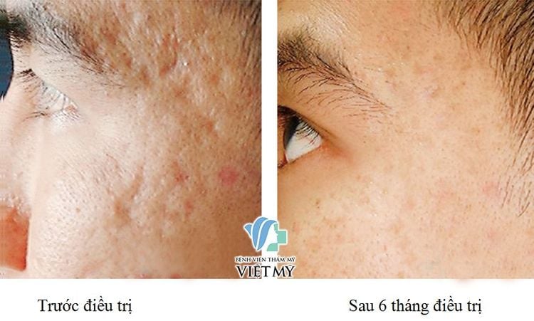 Điều Trị Mụn, Sẹo Xấu, Rạn Da Bằng Laser