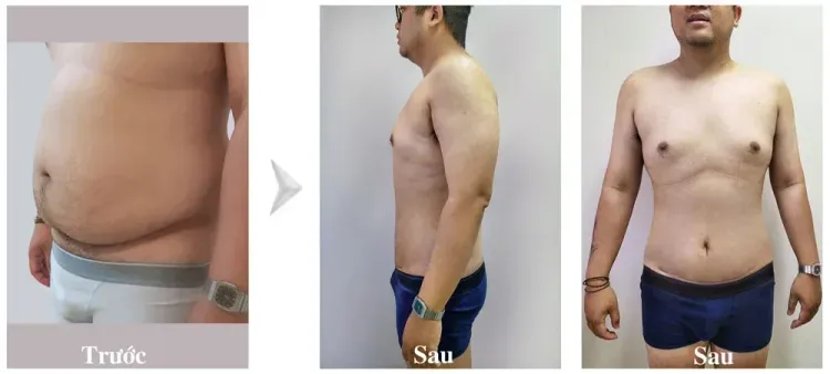 hình ảnh khách hút mỡ nâng mông sau 7 ngày