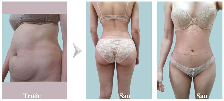 Hình ảnh trước và sau hút mỡ bụng
