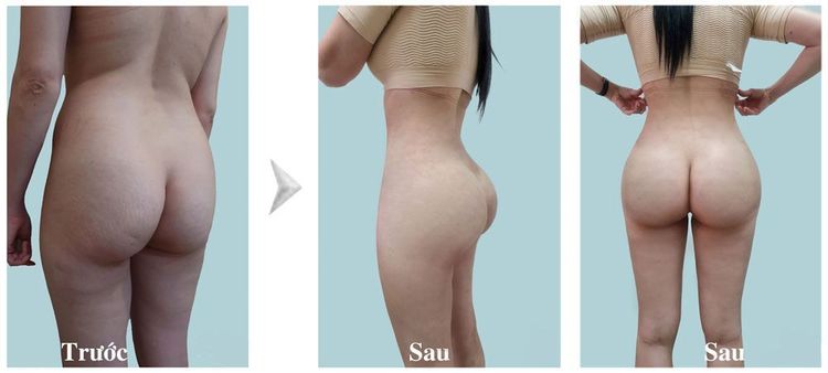 Hình ảnh trước và sau hút mỡ bụng sau 1 tháng