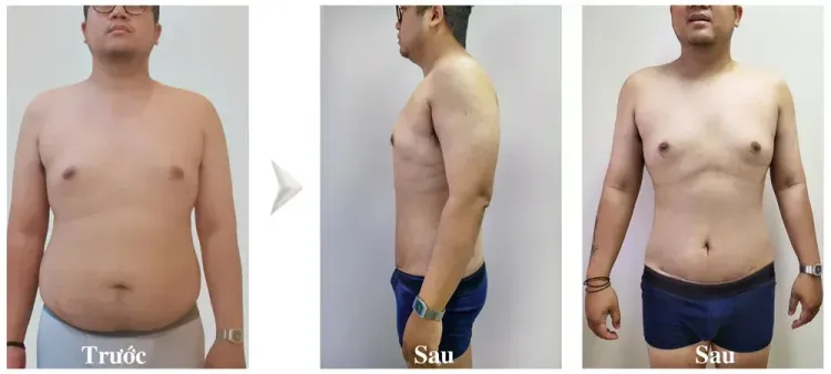 Khách hàng nam vừa hút mỡ bụng sau 7 ngày và sẽ cắt chỉ sau 10 ngày. Quá trình lành sẹo thay đổi giữa từng người và phụ thuộc vị trí đường vào, cơ địa, chăm sóc, kỹ thuật và các yếu tố khác.