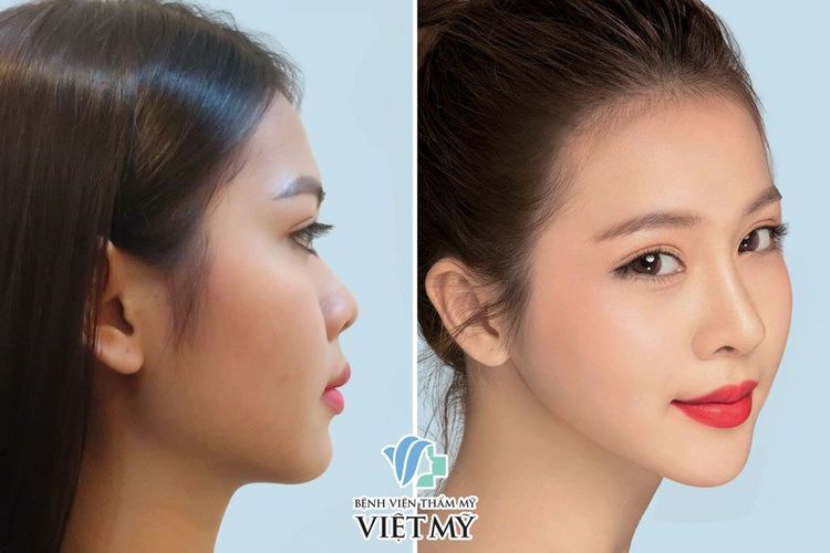 Hoa hậu Kim Ngọc trước và sau khi làm mũi và phẫu thuật thẩm mỹ toàn diện.