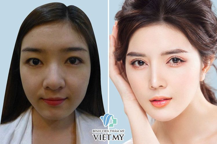 Lily Luta Trước và sau khi phẫu thuật Cắt mí mắt.