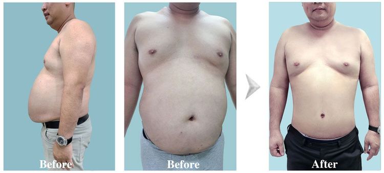 The client just had liposuction and abdominoplasty after 7 days