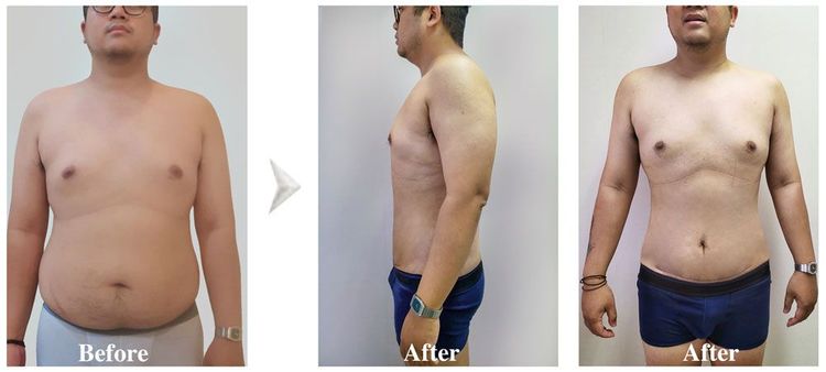 The client just had liposuction and abdominoplasty after 7 days