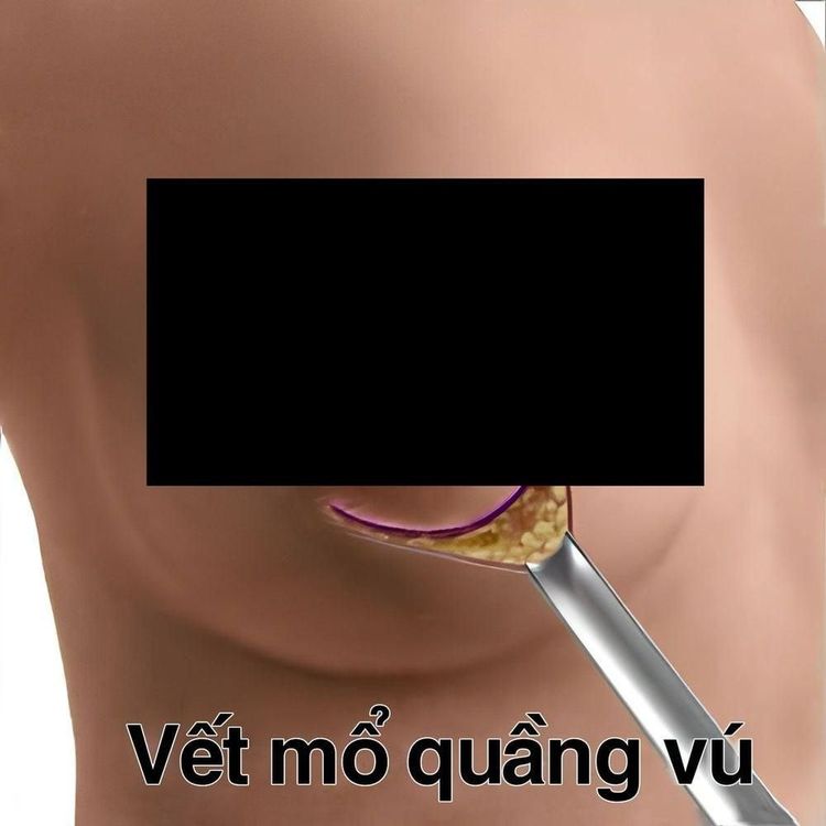 Bác sĩ sẽ đặt túi ngực thông qua đường rạch nhỏ theo viền quầng vú.