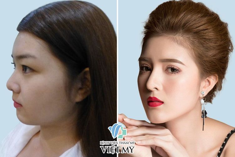 Before and after eyelid surgery