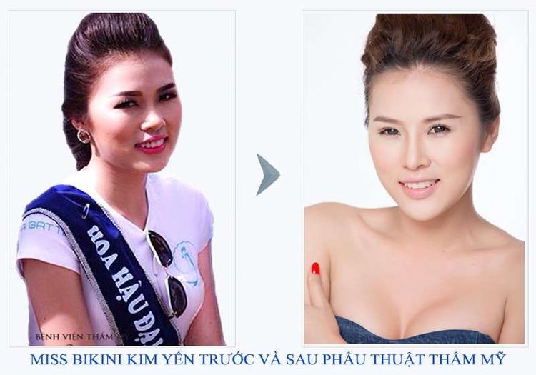 THU GỌN MẶT V-LINE