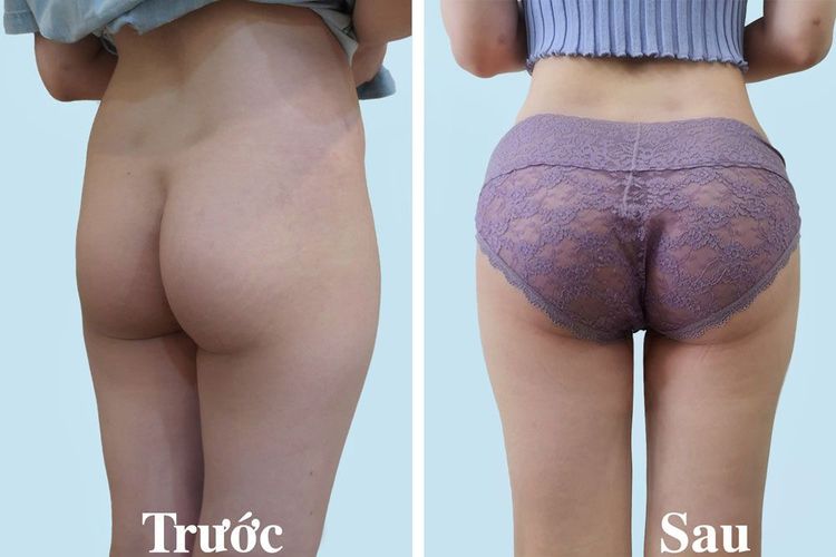 khách hàng trước và sau nâng mông chảy xệ