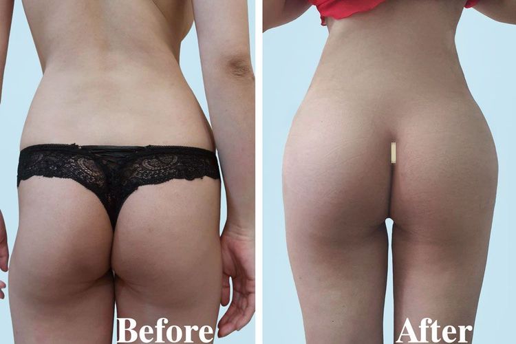 A 28-year-old client before and after 2 days of undergoing endoscopic butt lift and liposuction of the flanks.